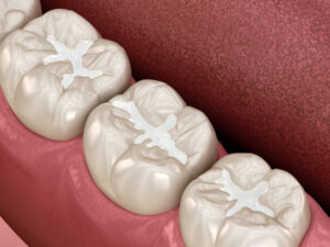 aesthetics composite dentistry tooth colored fillings