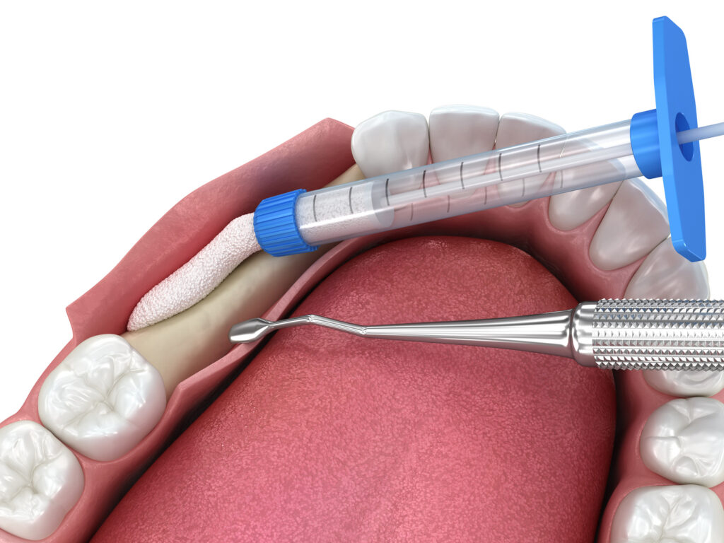 3D illustration of bone grafting for tooth implantation