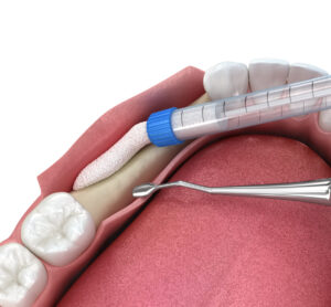 3D illustration of bone grafting for dental implants
