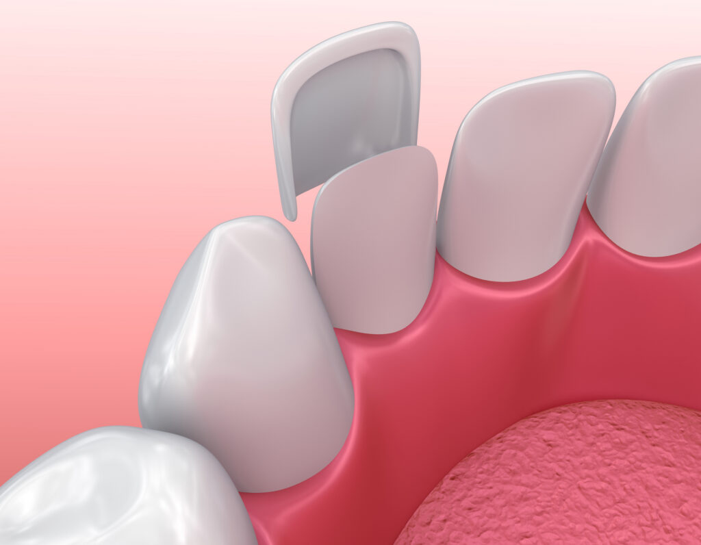 3D illustration of dental veneer installation process