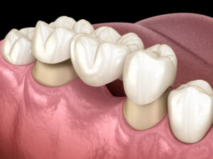 3D illustration of a dental bridge over molar and premolar