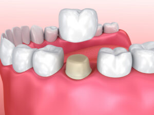 3D illustration of dental crown installation process