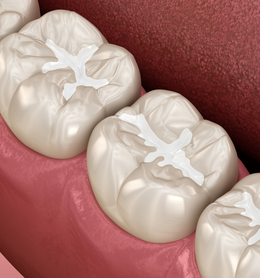 Dental Fillings Tooth Seamless Effective Restorations