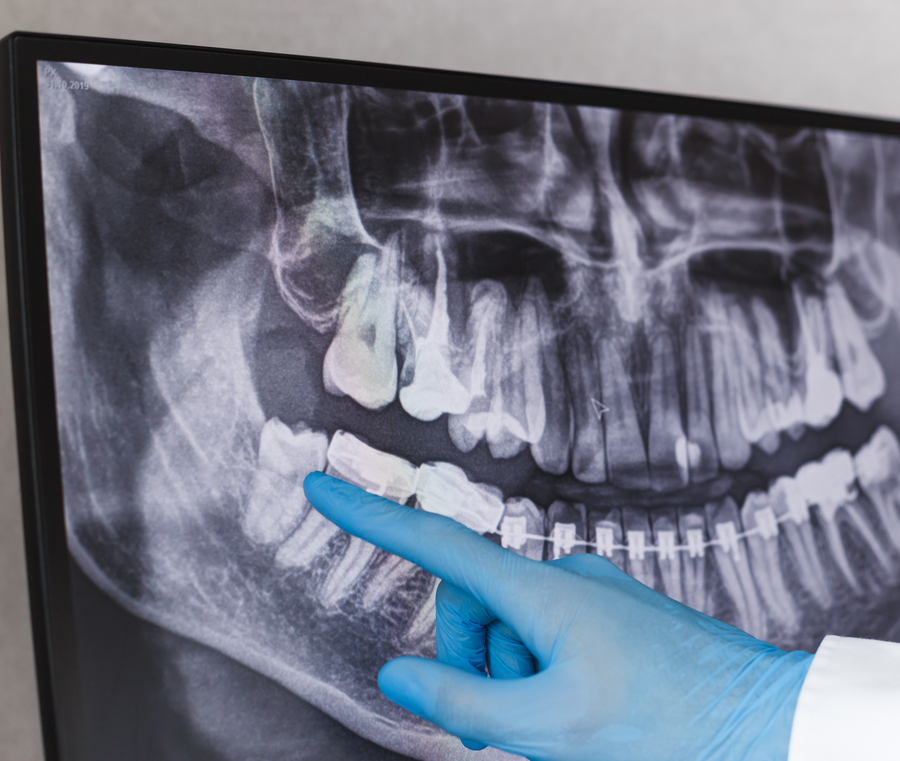 Doctor pointing at wisdom tooth in dental x-ray