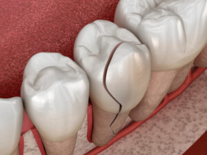 3D illustration of a cracked tooth for emergency dentistry