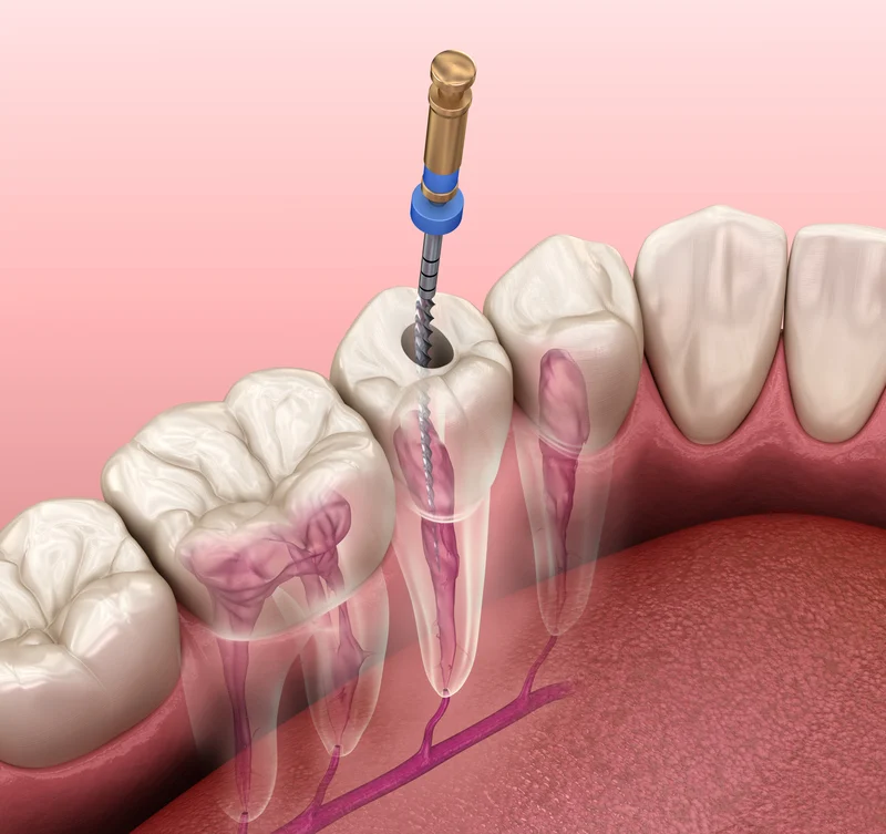 endodontic root canal treatment process