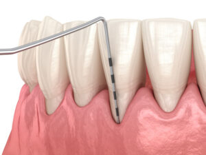 3D illustration of gum recession and periodontal care