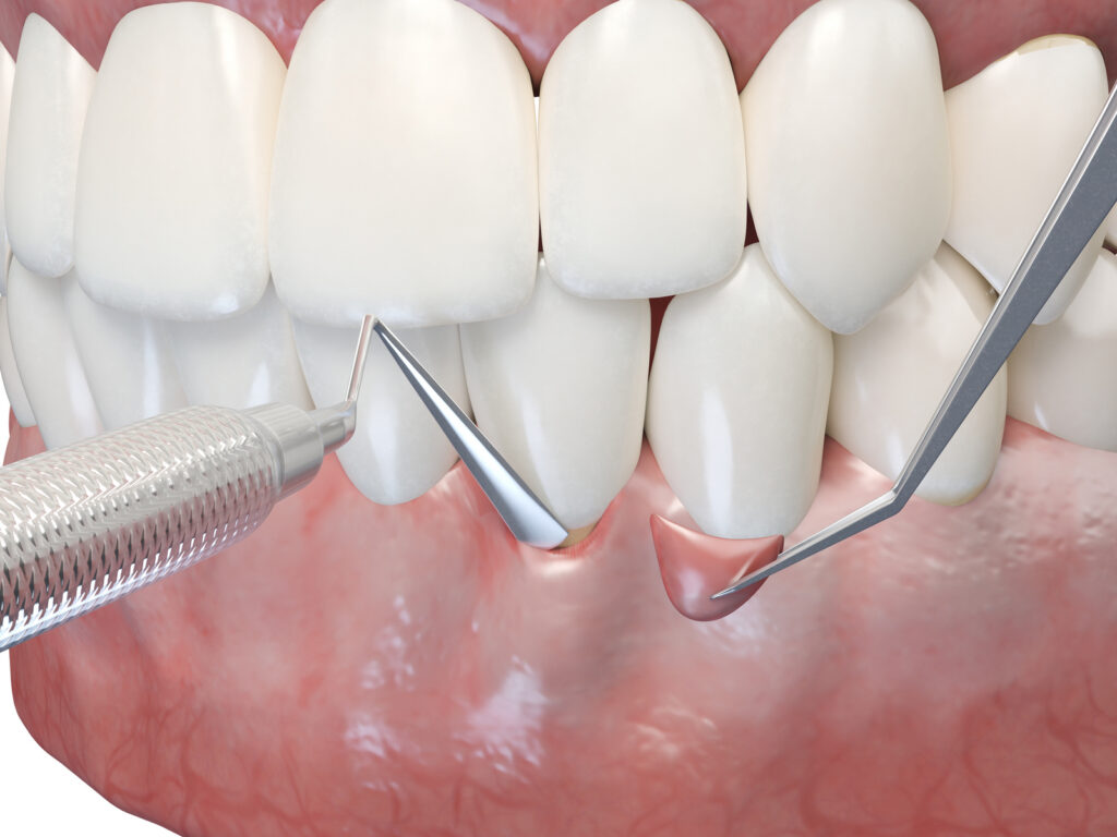 3D illustration of a gum graft surgery procedure