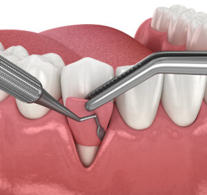 3D illustration of gum grafting surgery for recession