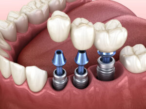 3D illustration of crowns placed on dental implants