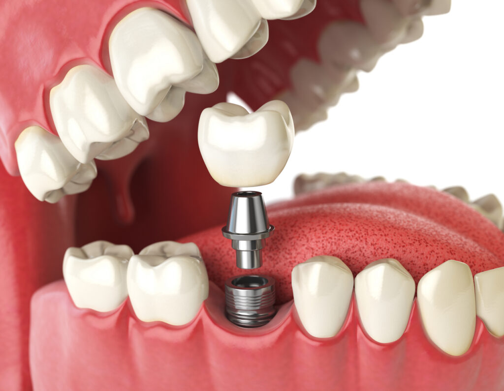 Close-up of a dental implant with a crown