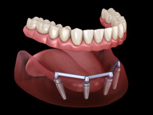 3D illustration of implant-supported dentures