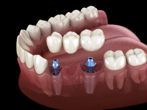 3D illustration of dental bridge supported by implants