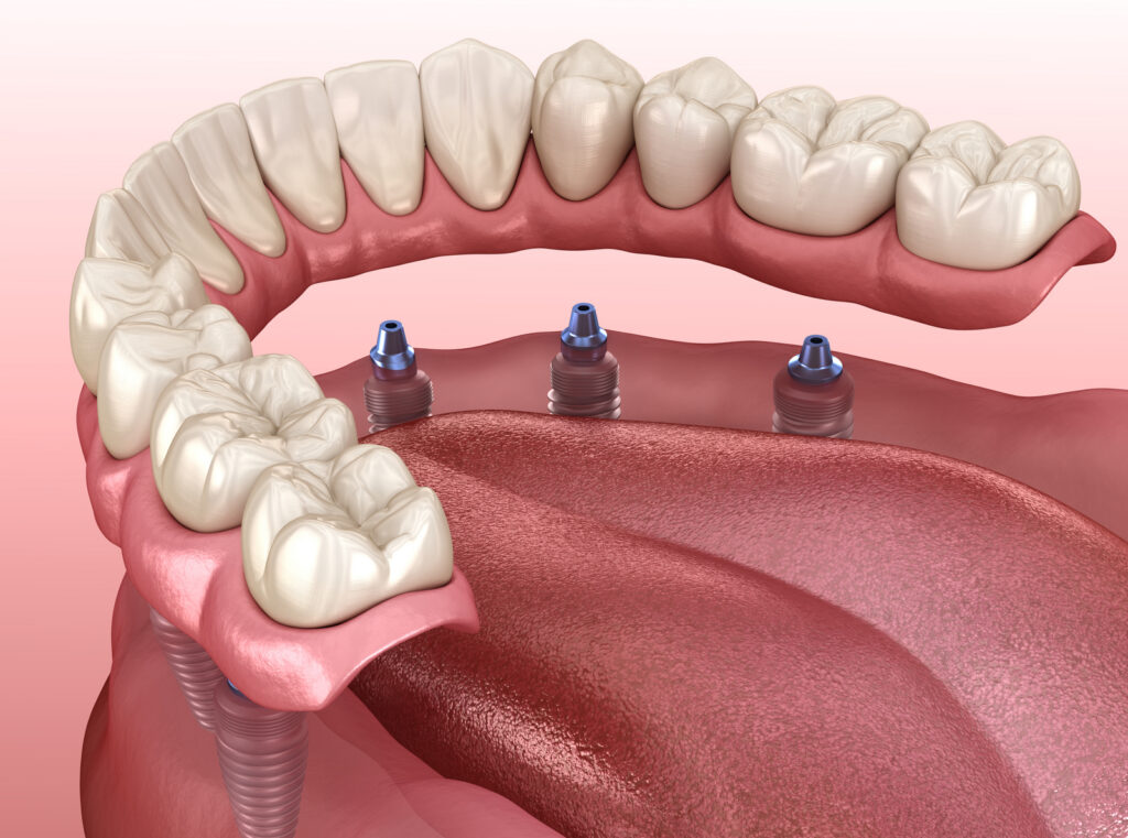 3D illustration of mandibular prosthesis supported by implants