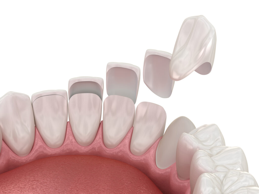 3D illustration of dental veneer placement on teeth