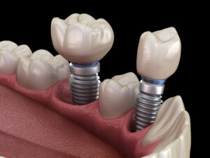 3D illustration of dental crowns on implant abutments
