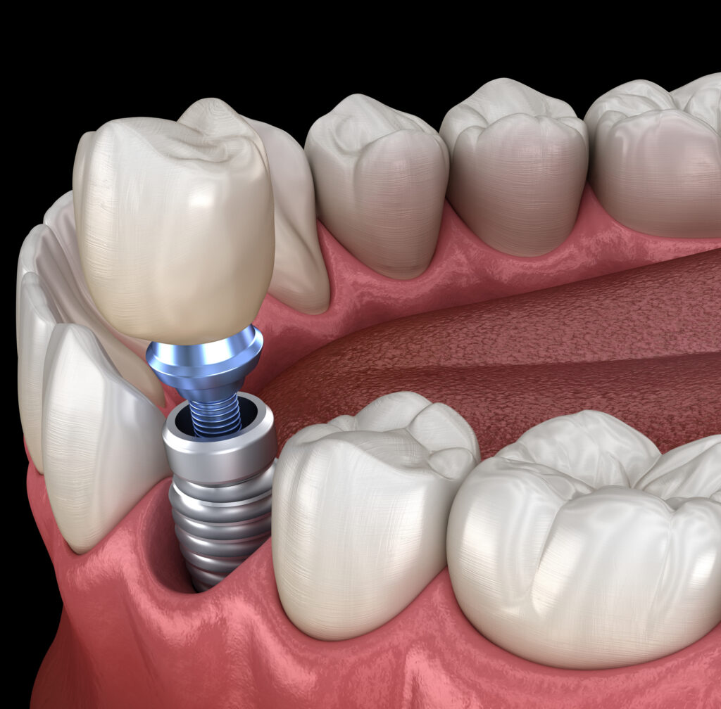 3D illustration of premolar tooth recovery with implant