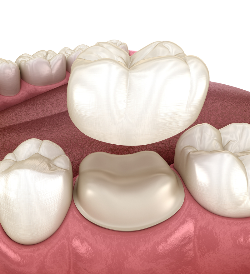 3D illustration of prepared molar for dental crown