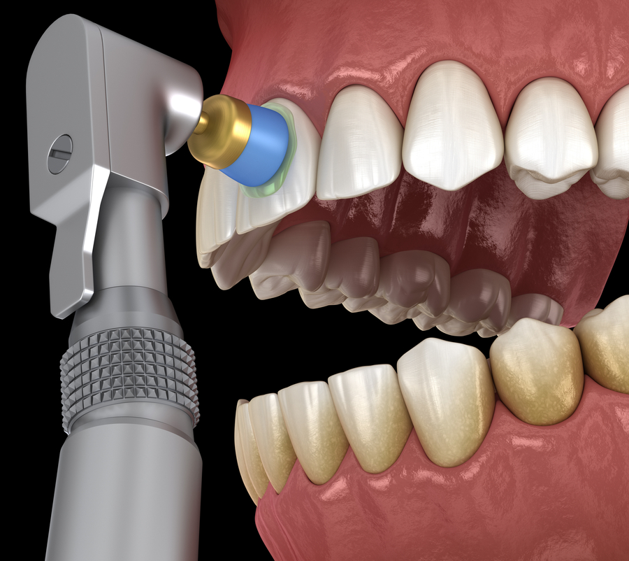 Professional Prophylaxis Teeth Cleaning