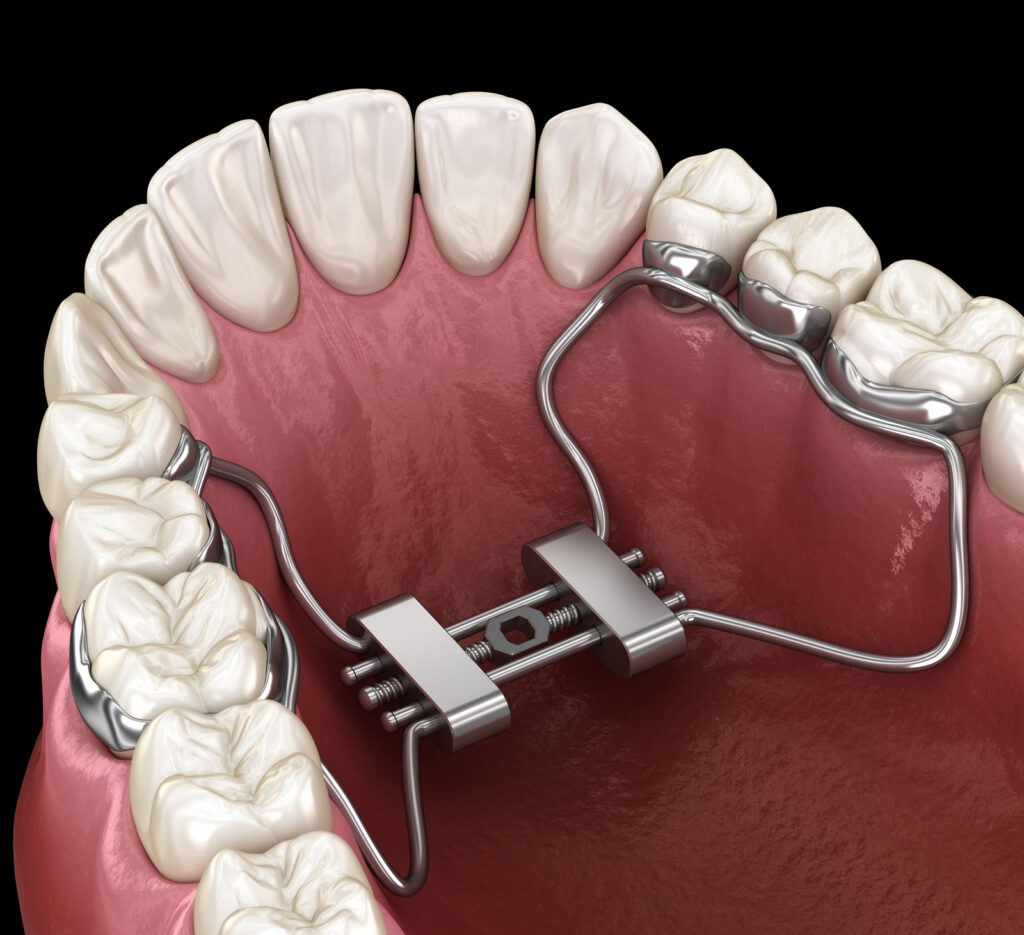 3D illustration of rapid palatal expansion for dental care