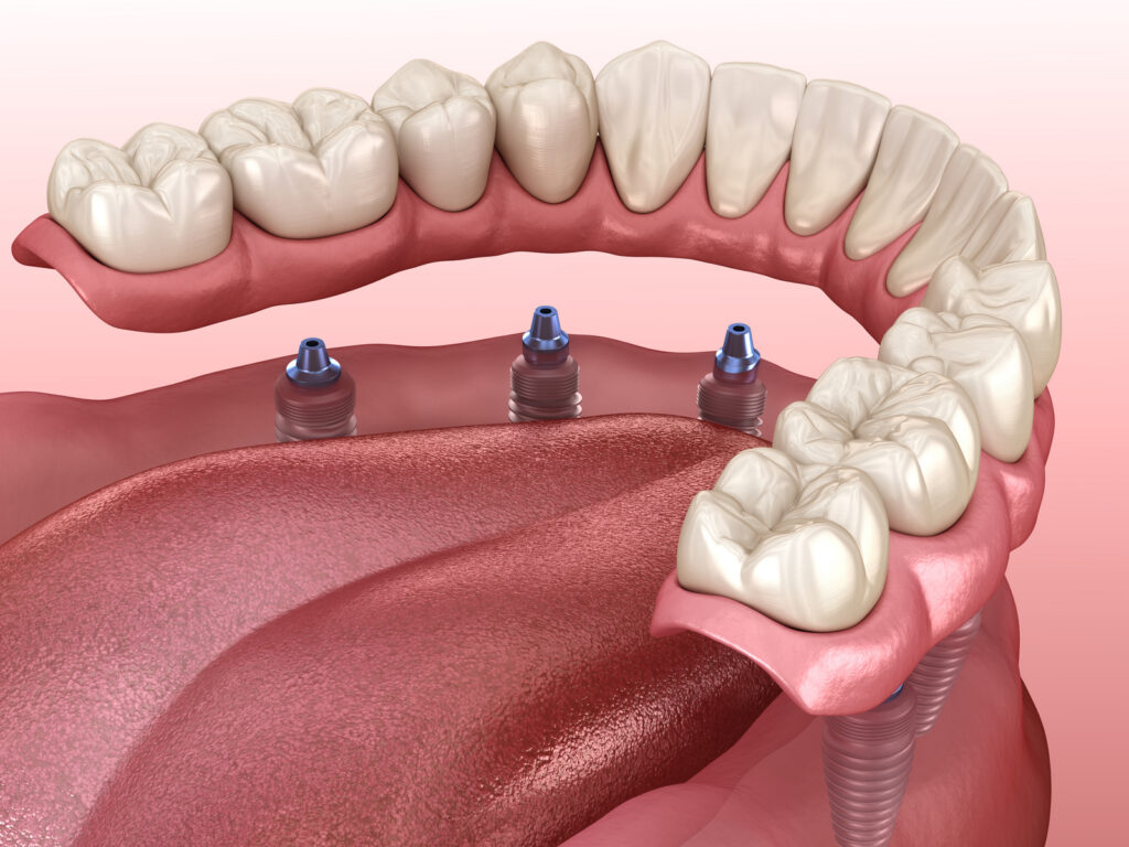 removable partial denture