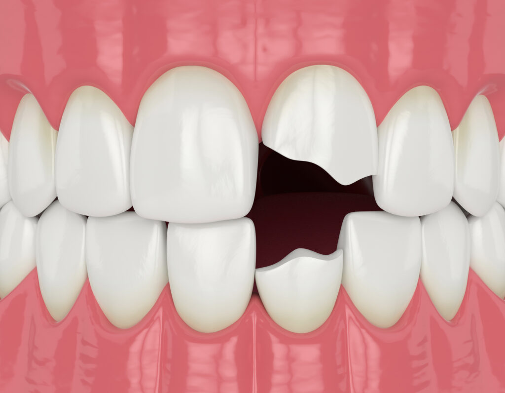 3D render of jaw with broken incisor teeth