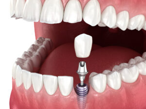 3D illustration of a dental implant and ceramic crown