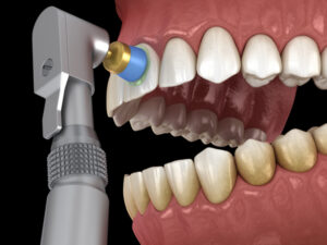 3D illustration of a teeth polishing procedure with gel