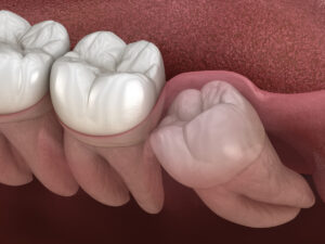 3D illustration of healthy teeth and impacted wisdom tooth