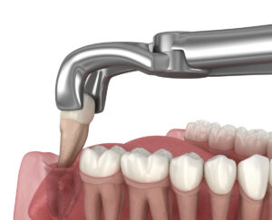 3D illustration of a wisdom tooth extraction procedure