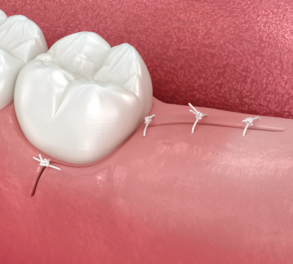 3D illustration of stitches on gum after extraction
