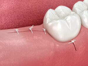 3D illustration of stitches on gum after tooth extraction