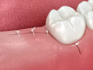 3D illustration of stitches on gum after tooth extraction