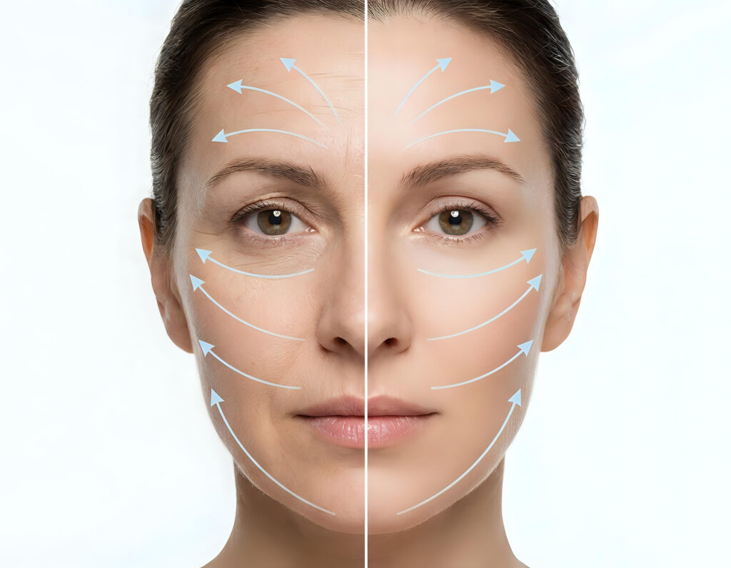 Young woman with markings for wrinkle reduction treatment